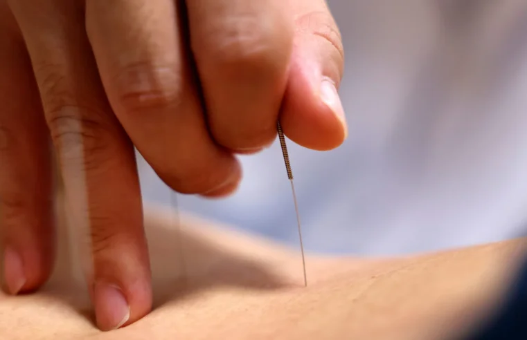 6 principais benefícios da Acupuntura, segundo especialistas