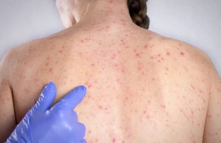 Ilhabela atinge 95% de cobertura viral e intensifica multivacinação