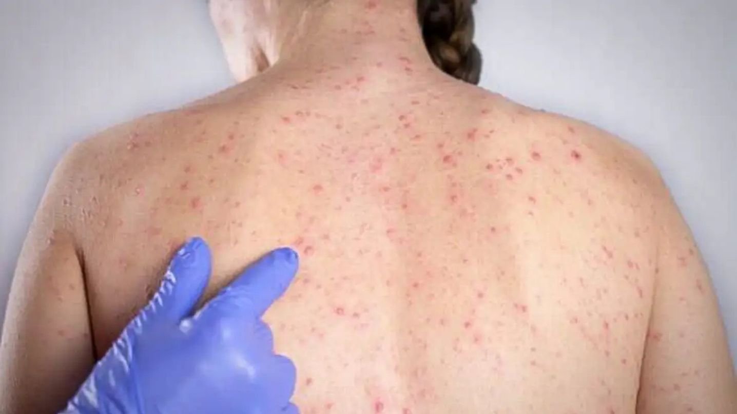 Ilhabela atinge 95% de cobertura viral e intensifica multivacinação
